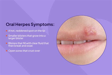 hermes syndrome|herpes disease is caused by.